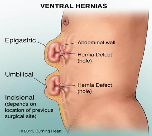 Description: Image result for hernia EPIGASTRIC