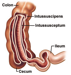 Description: Image result for intussusception