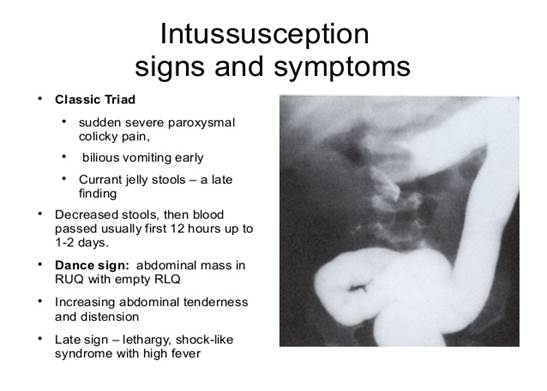 Description: Image result for dance sign intussusception